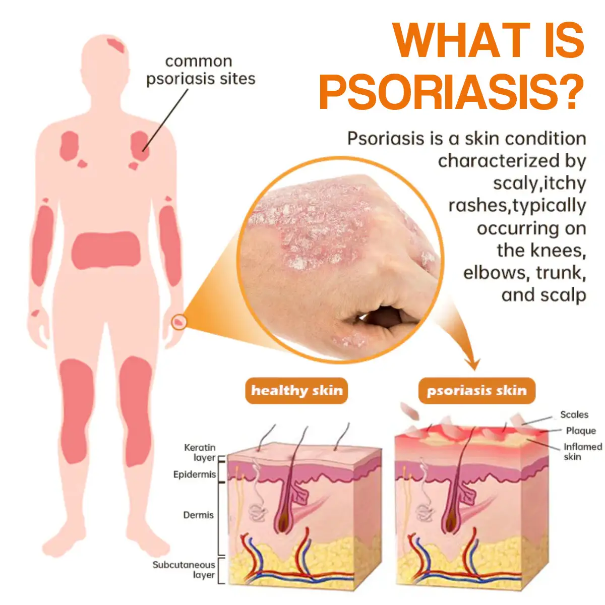 PsoriaHeal Bee Venom Psoriasis Treatment Spray - Image 6