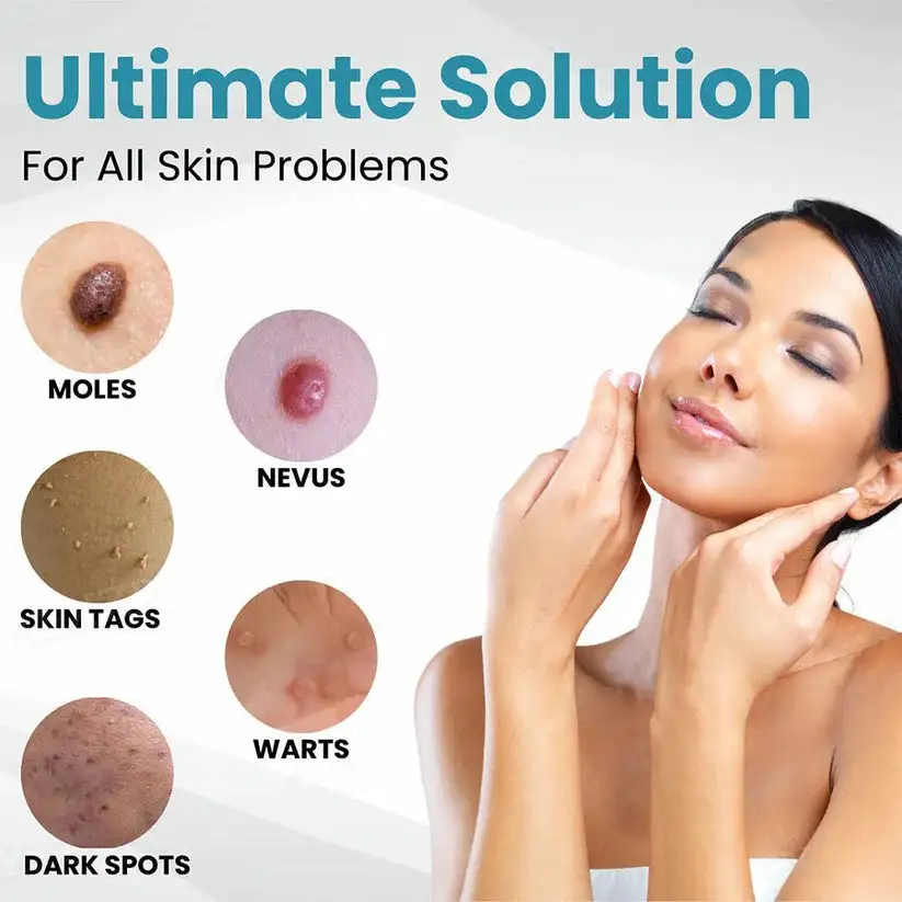 Non-Invasive Mole and Wart Removal Laser Pen - Image 3
