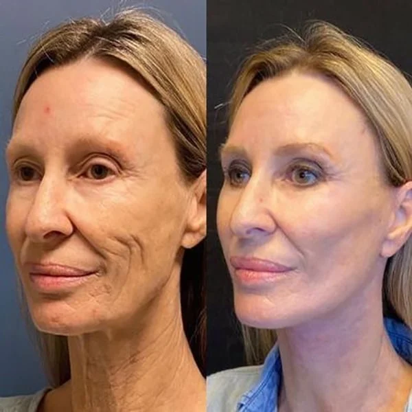 Oveallgo ™ Youthfully Botox Face Serum - Image 5