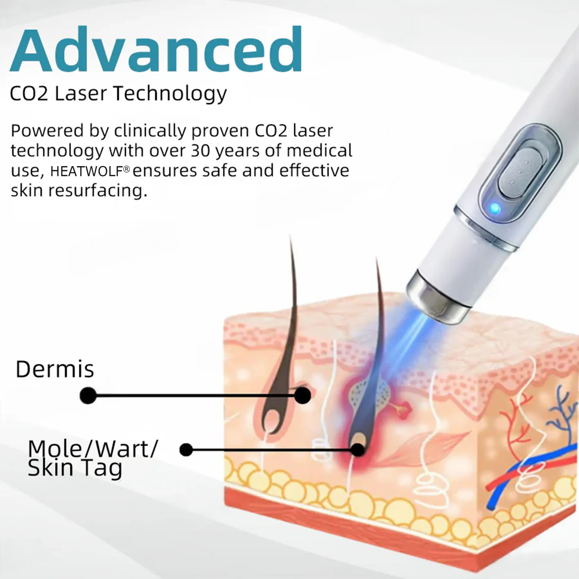 Non-invasive Mole & Wart Removal Laser Pen - Image 7
