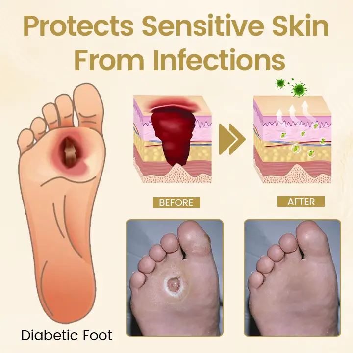 Diabetic Foot Healing Spray - Bee Venom Infused - Image 3