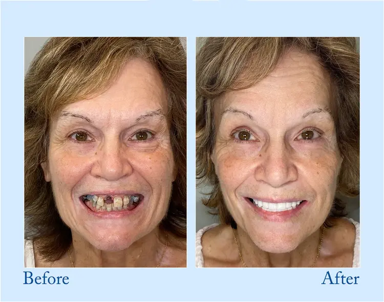 Custom-Fit Functional Dentures – Full Set - Image 11
