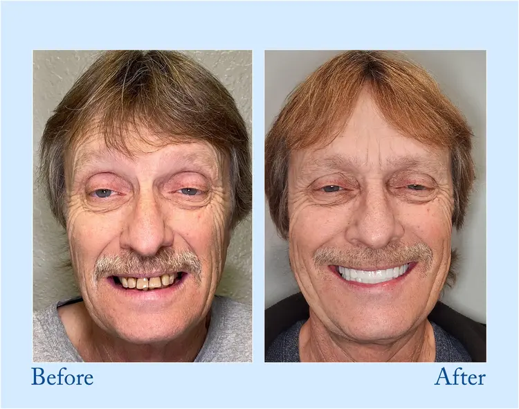 Custom-Fit Functional Dentures – Full Set - Image 8