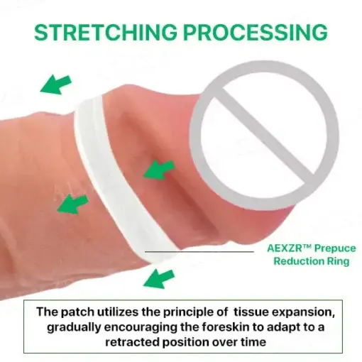Prepuce Reduction Ring - Image 3