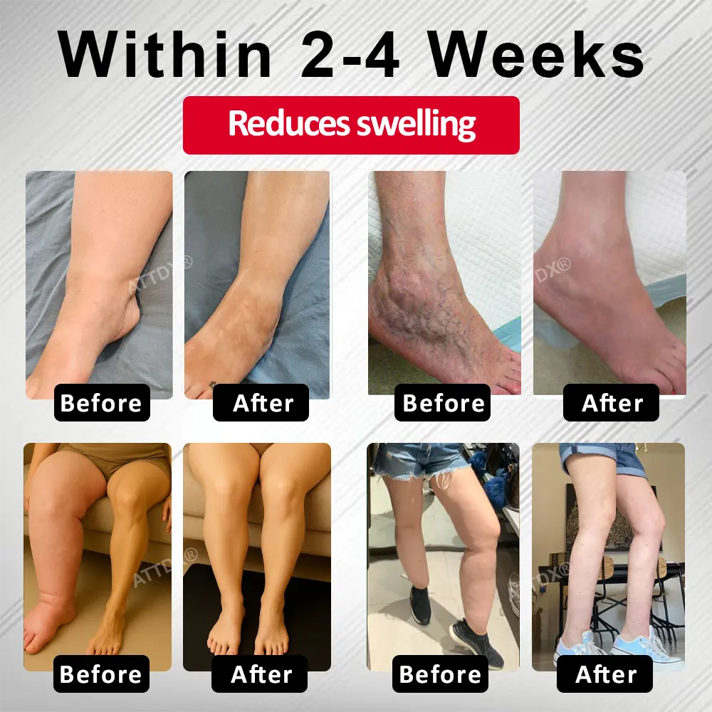 Advanced CVI Edema Therapy Cream - Image 2