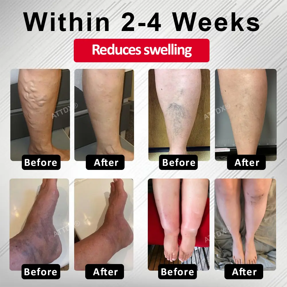 Advanced CVI Edema Therapy Cream - Image 3