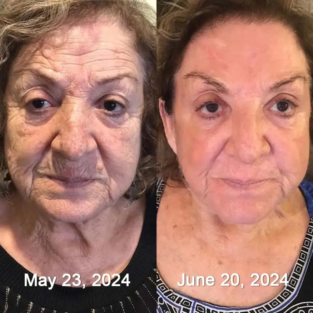 Botox & Retinol Shot - Eraser for deep wrinkles - Image 21