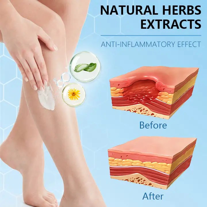 Varicose Veins Cream with Hydrogel - Image 5