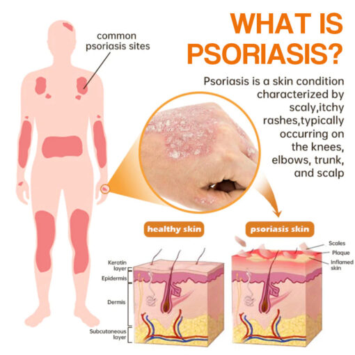 PsoriaHeal Bee Venom Psoriasis Treatment Spray plus - Image 9