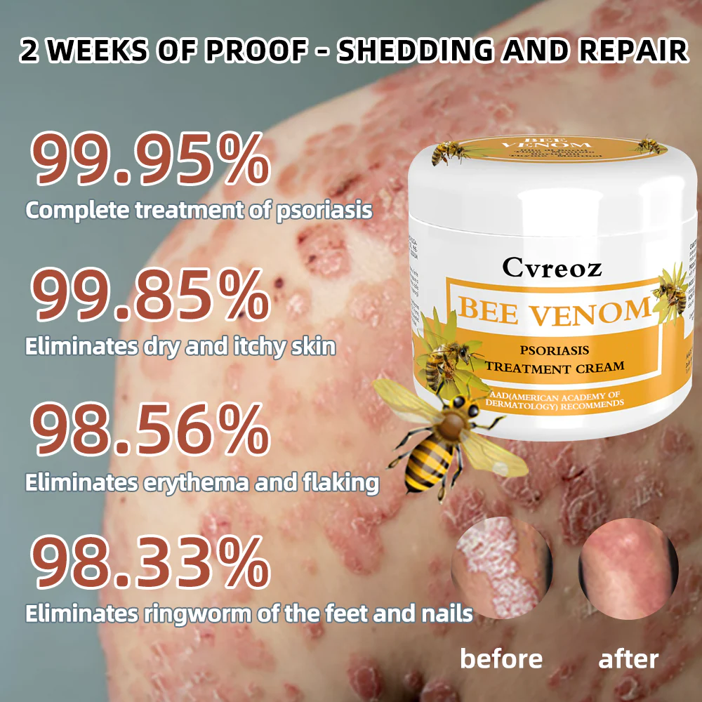 Cvreoz Bee Venom Psoriasis Treatment Cream - Image 5