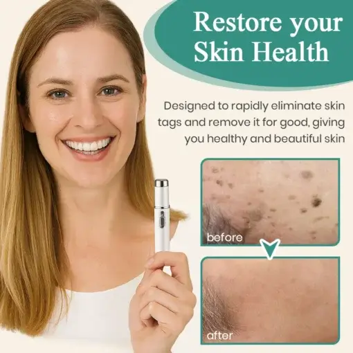 LumeSkin Mole and Wart Instant Removal Laser Pen - Image 6
