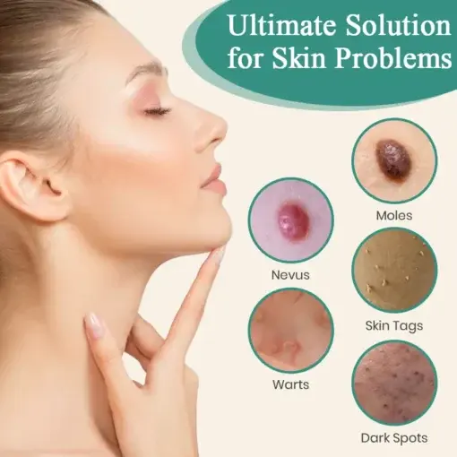 LumeSkin Mole and Wart Instant Removal Laser Pen - Image 8