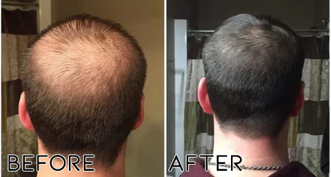 Minoxidil Hair Regrowth Treatment - Image 3