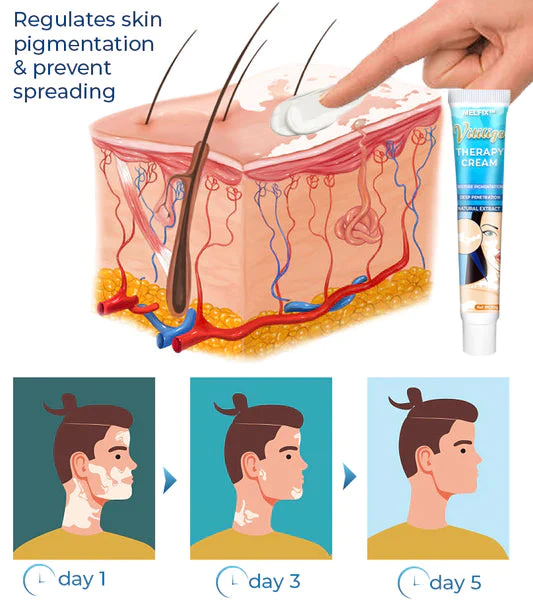 Vitiligo Therapy Cream - Image 3