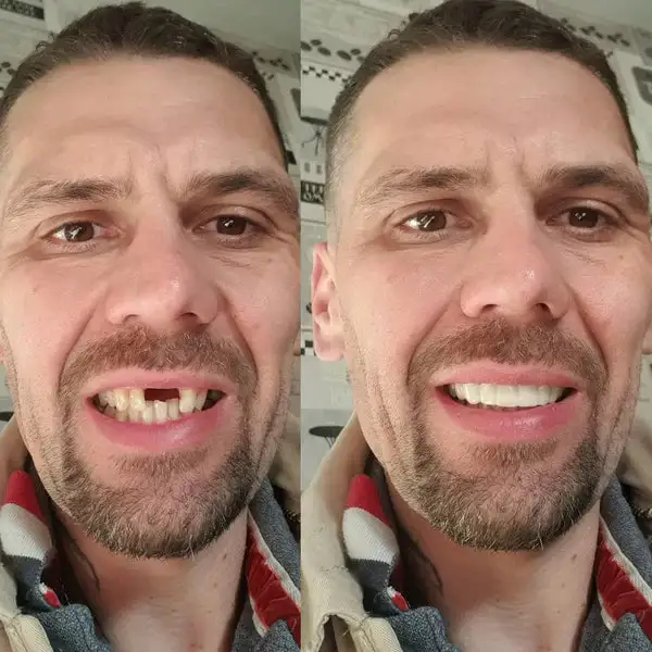 BioFusion Dentures - Image 4