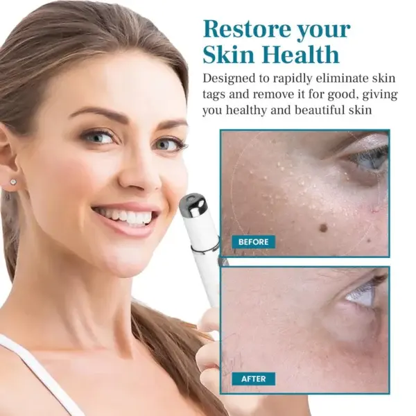 LumeSkin Mole and Wart Removal Laser Pen - Image 3
