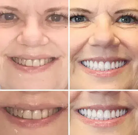SmileFitPro Premium Denture - Image 6