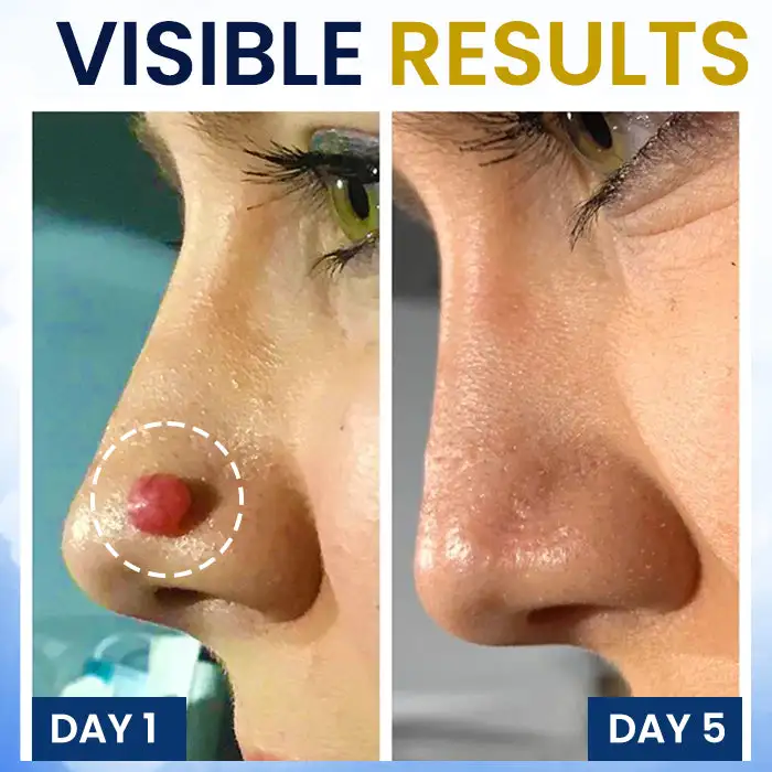 Warts No More - 50% OFF | Skin Tag Cryo Treatment Spray - Image 3