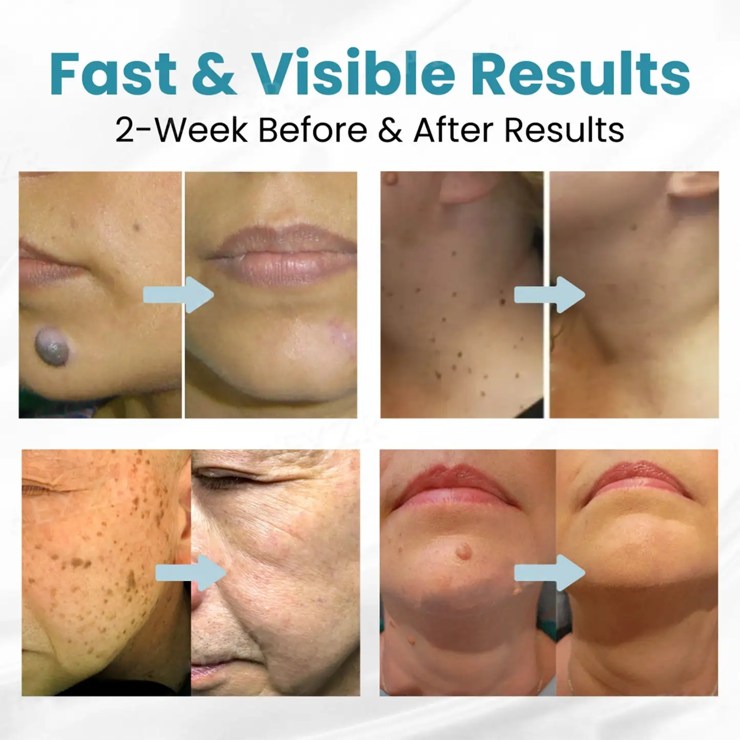 non-invasive laser pen delivers hospital-grade results at home - Image 2