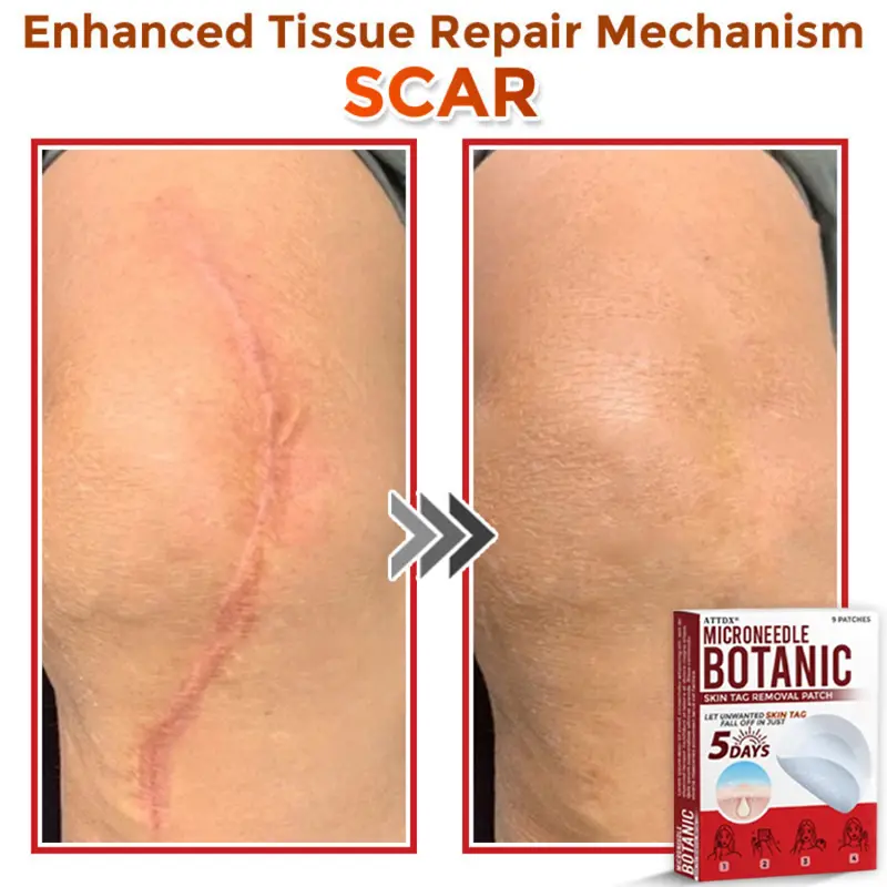 MicroNeedle Botanic Skin Tag Removal Patch - Image 12