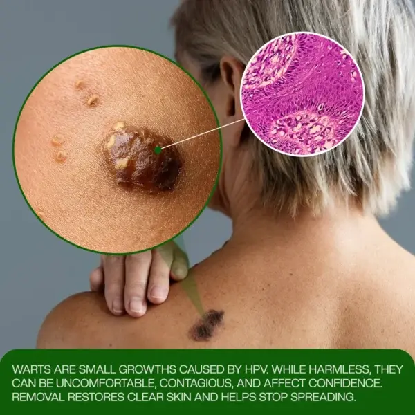 ClinixClear Wart Remover Patch - Image 5