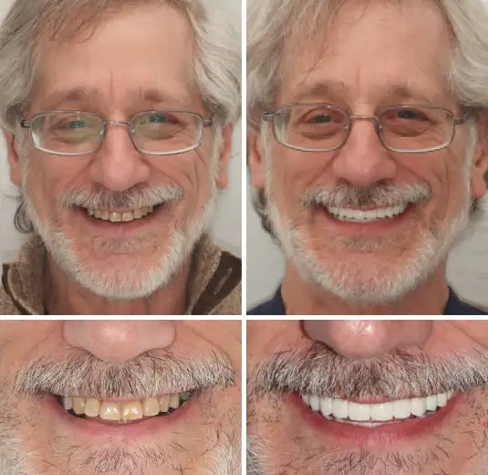 Custom-Fit Functional Dentures - Image 3