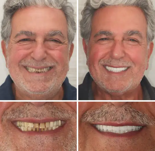 Custom-Fit Functional Dentures - Image 5