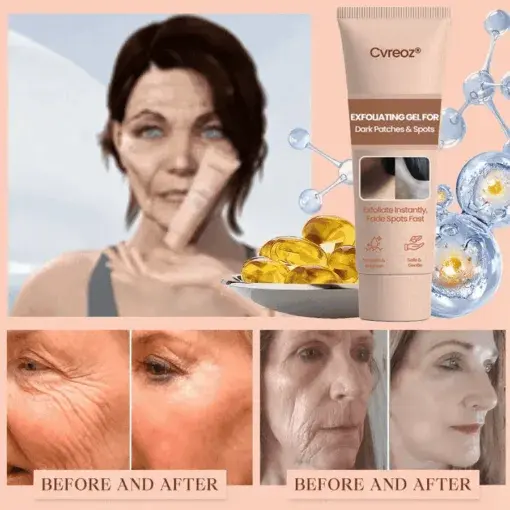 Purifying Exfoliating Gel for Acanthosis Nigricans, Exfoliation, Dark Spots, Skin Tags, and Eczema - Image 11