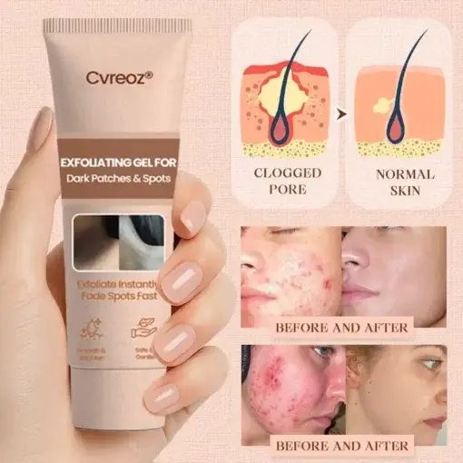 Purifying Exfoliating Gel for Acanthosis Nigricans, Exfoliation, Dark Spots, Skin Tags, and Eczema - Image 7
