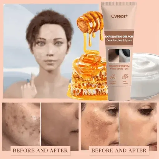 Purifying Exfoliating Gel for Acanthosis Nigricans, Exfoliation, Dark Spots, Skin Tags, and Eczema - Image 8