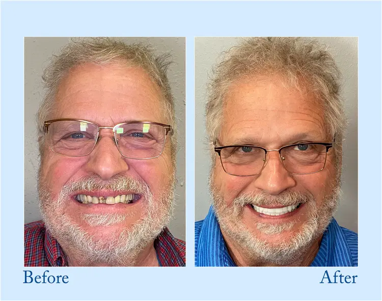 Custom-Fit Functional Dentures - Image 12