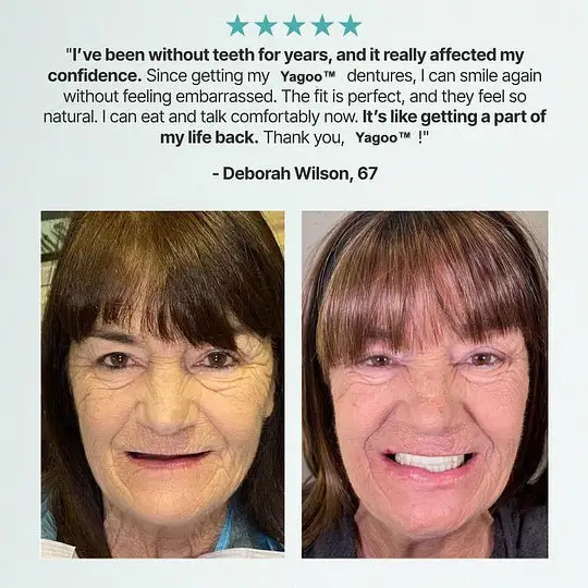 💗Ends Today: 70% OFF! Custom Custom-Fit Full Functional DenturesMake you more confident - Image 10