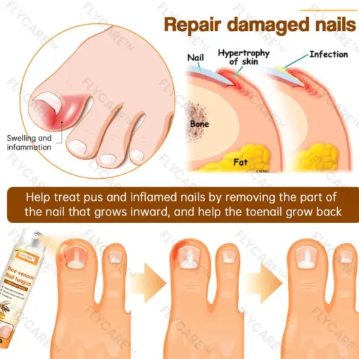 Bee Venom Nail Fungus Spray - Image 3