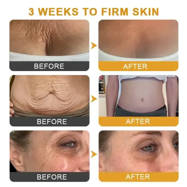 Botox Bee Venom Wrinkle - Image 8