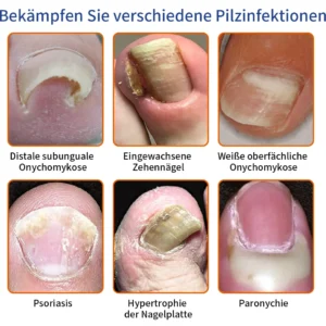 Alternative view of Bee Venom Nail Fungus Treatment Solution