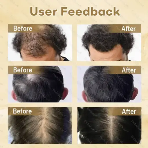 Hair Regrowth Capsules Nano Penetration, Deep into Hair Roots - Image 2