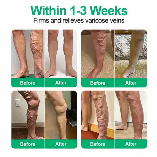 VeinEase Microneedle Care PatchInstant Relief, Long-Term Results - Image 2