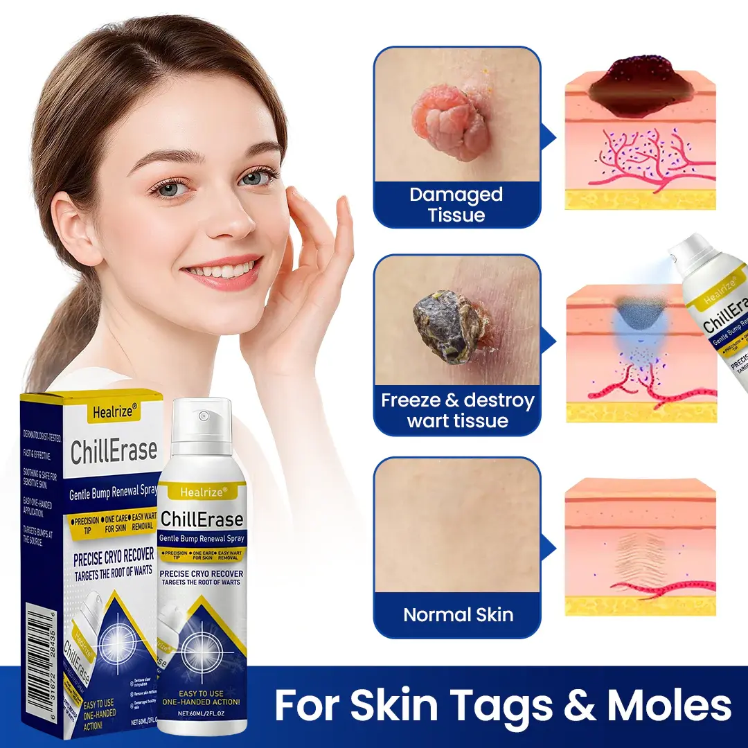 ChillErase Gentle Bump Renewal Spray✨ — Pain-Free, Acid-Free Gentle Wart Removal - Image 2