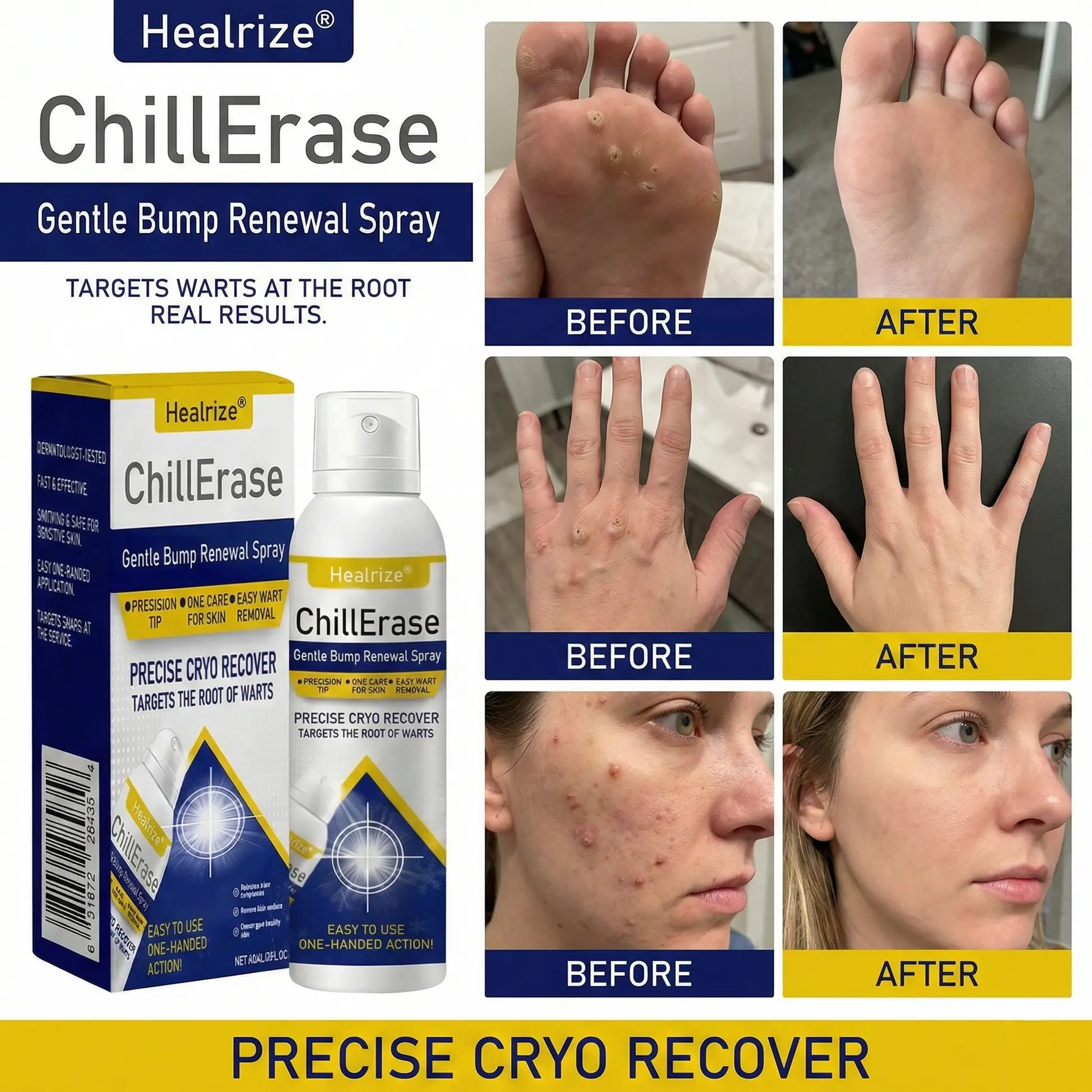 ChillErase Gentle Bump Renewal Spray✨ — Pain-Free, Acid-Free Gentle Wart Removal - Image 3