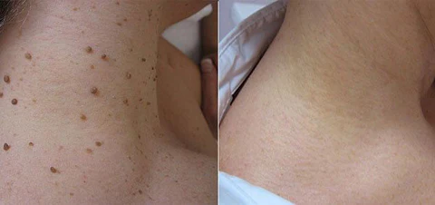 Bee Venom Mole and Wart Treatment Cream - Image 8