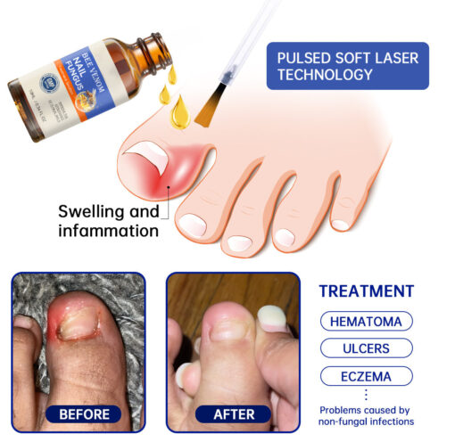 Bee Venom Nail Fungus Treatment Solution - Image 6