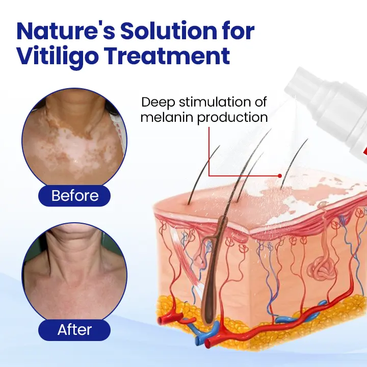 Vitiligo Treatment Spray - Image 2