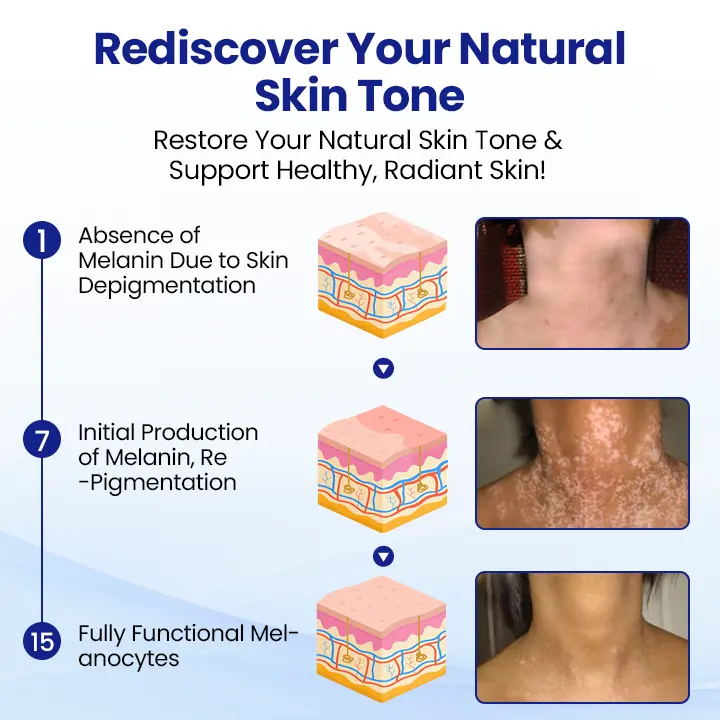 Vitiligo Treatment Spray - Image 4