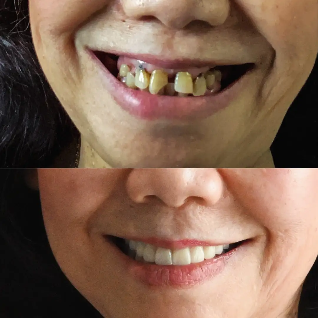 BioFusion Dentures - Image 8