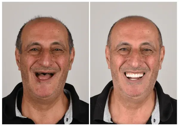 Custom-Fit Functional Dentures - Image 7