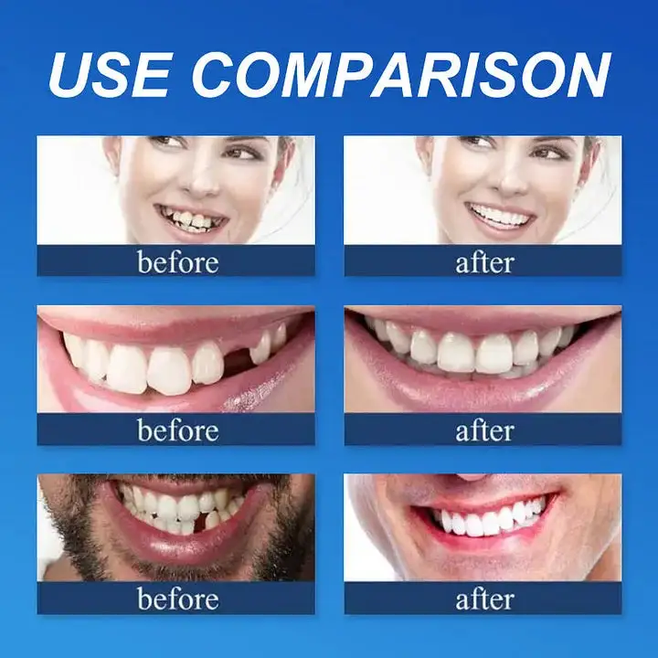 Medical Full Denture with Strong Suctiond Custom-Fit Full Functional Dentures - Image 6