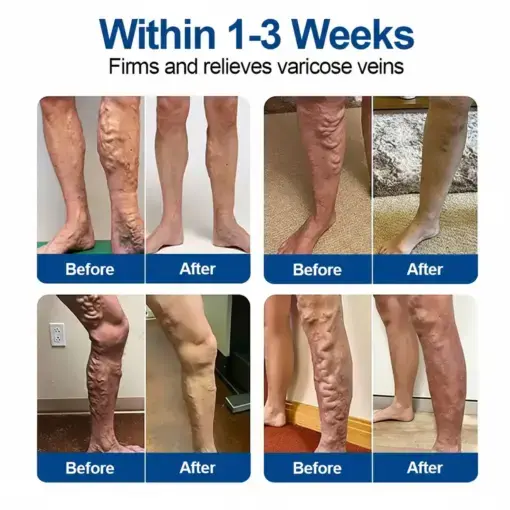 VeinEase Microneedle Care PatchInstant Relief, Long-Term Results - Image 3