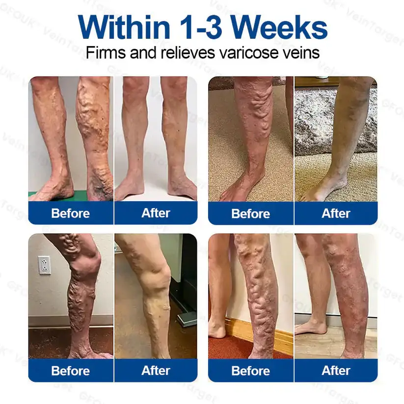 VeinTarget Microneedle Patch⚡Instant Relief, Long-Term Results - Image 2