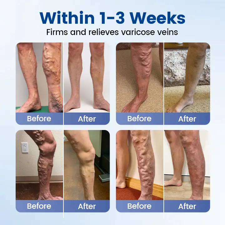 Vein Ease Microneedle Therapy Patch🔥 - Image 10