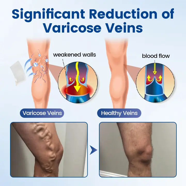 Vein Ease Microneedle Therapy Patch🔥 - Image 5
